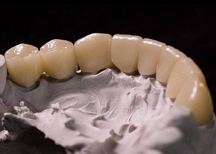Porcelana fundida con coronas metálicas: tecnología avanzada para restaurar una sonrisa duradera