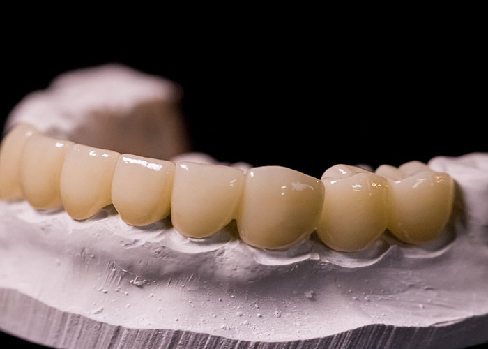 Porcelana fundida con coronas metálicas: tecnología avanzada para restaurar una sonrisa duradera