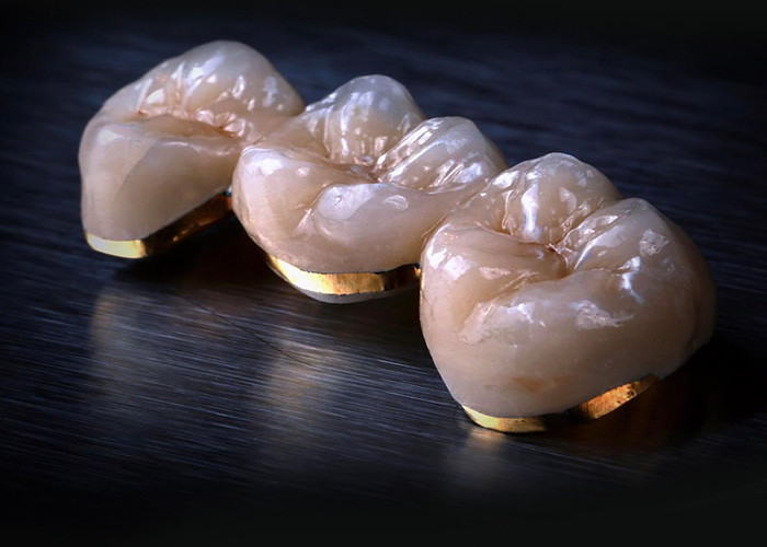 Porcelana fundida con coronas metálicas: tecnología avanzada para restaurar una sonrisa duradera
