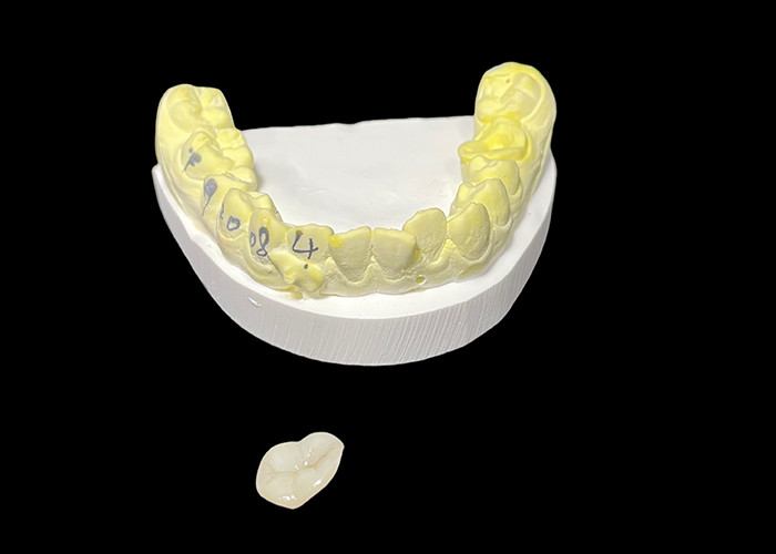Inlays y onlays de cerámica dental hechos a medida para soluciones restaurativas y reparación de dientes dañados