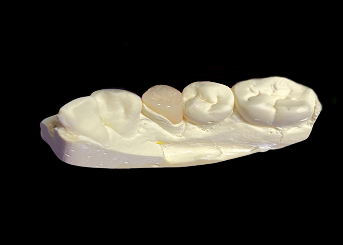 Inlays y onlays de cerámica dental hechos a medida para soluciones restaurativas y reparación de dientes dañados