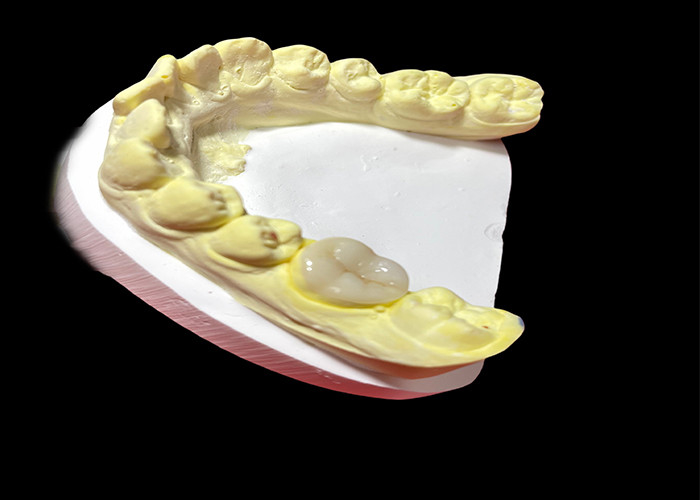 Enlaces y incrustaciones de cerámica de alta calidad para la restauración dental sin costuras y de larga duración