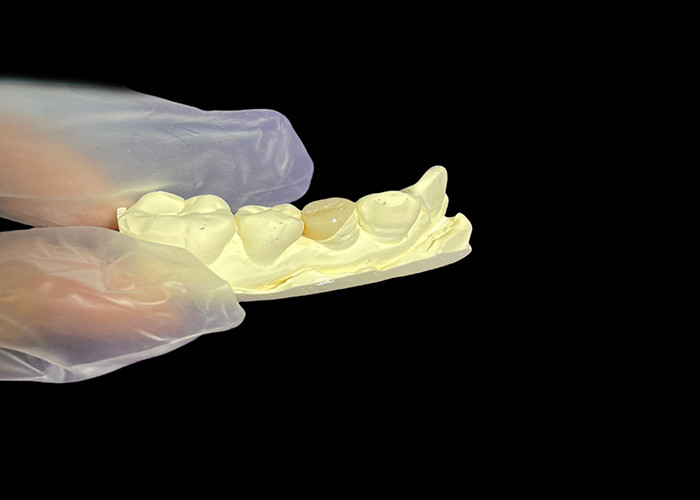 Inlay dental de cerámica para una reparación efectiva de los dientes con soluciones de porcelana duraderas y estéticas para una restauración duradera