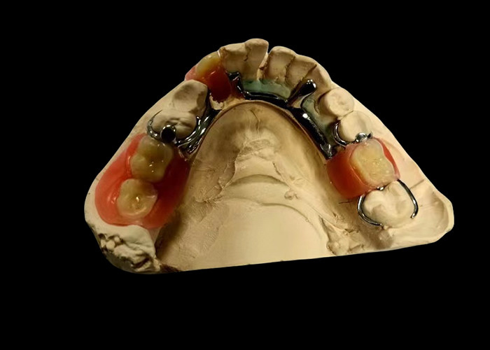 Dentadura removible parcial de base metálica y resina acrílica para un ajuste seguro y una apariencia natural