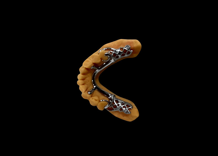 Dentadura removible parcial de base metálica y resina acrílica para un ajuste seguro y una apariencia natural