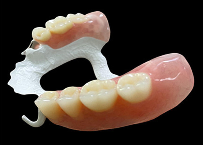Dentadura extraíble parcial personalizada con marco de polímero de alto rendimiento (HPP) para mayor comodidad y durabilidad