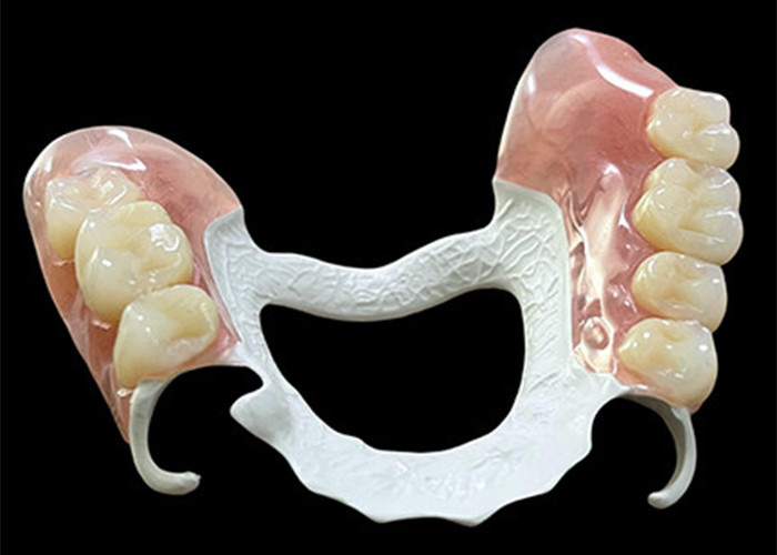 Dentadura extraíble parcial personalizada con marco de polímero de alto rendimiento (HPP) para mayor comodidad y durabilidad