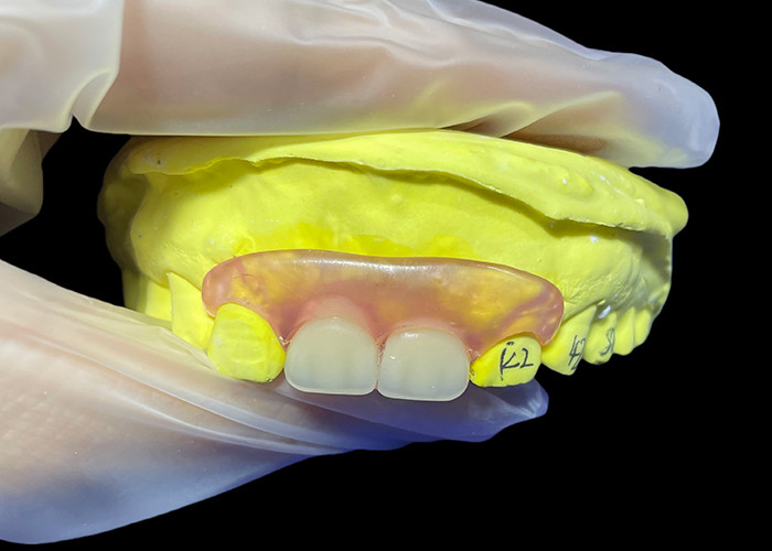 Sustitución de dentadura parital flexible para masticar y hablar cómodamente
