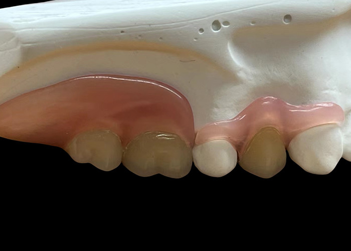 Dentes flexibles invisibles ajustables: adecuados para masticar y hablar cómodamente con una durabilidad variable