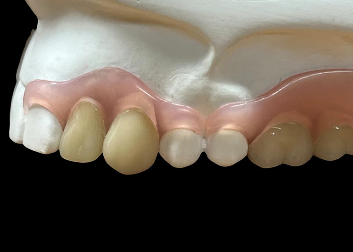 Dentes flexibles invisibles ajustables: adecuados para masticar y hablar cómodamente con una durabilidad variable