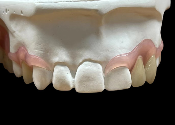 Sustitución de dentadura parital flexible para masticar y hablar cómodamente