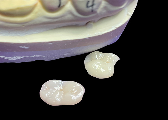IPS e.max Inlays y onlays cerámicos para la restauración molar Estética natural y durabilidad superior para resultados duraderos