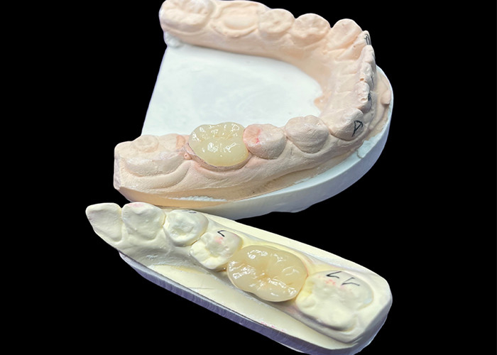 IPS e.max Inlays y onlays cerámicos para la restauración molar Estética natural y durabilidad superior para resultados duraderos