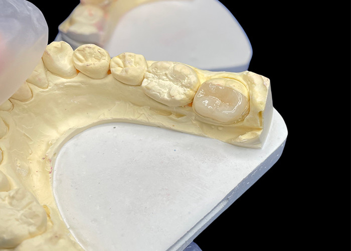 IPS e.max Inlays y onlays cerámicos para la restauración molar Estética natural y durabilidad superior para resultados duraderos