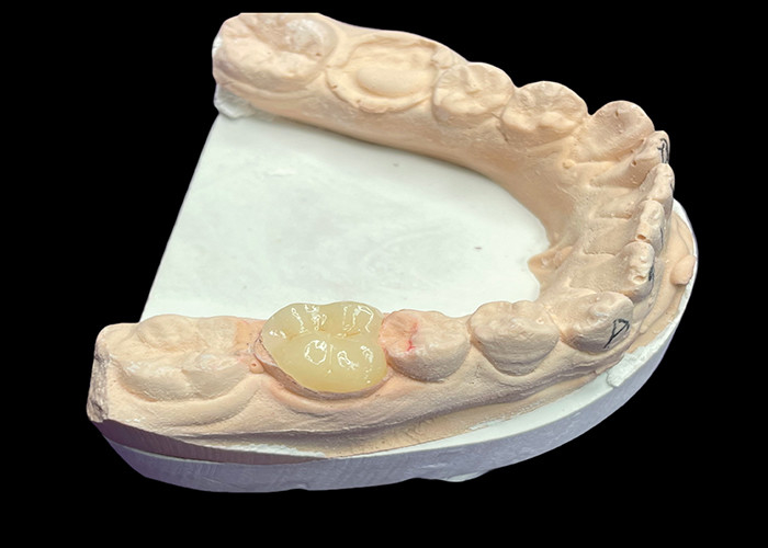 Incremento de cerámica dental suave a medida para reparación de dientes sin costuras resistentes a la tinción y estética natural