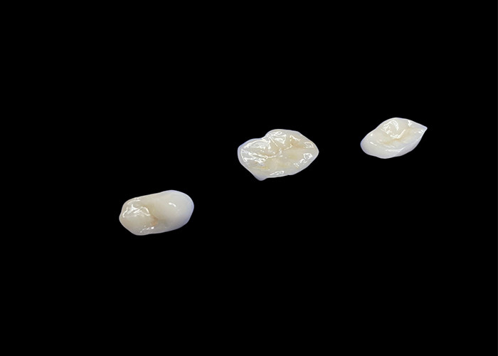 Inlays y onlays de cerámica biocompatibles diseñados para una durabilidad confortable e integración perfecta con los dientes naturales