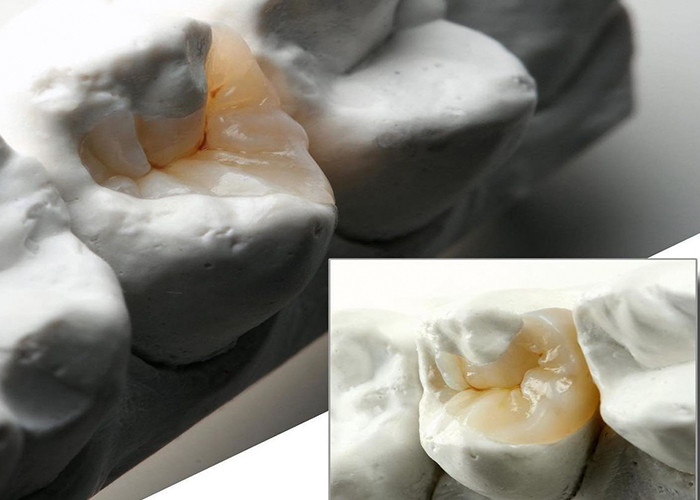 Inlays y onlays cerámicos de aspecto natural para restauración dental precisa de nuestro laboratorio dental experto