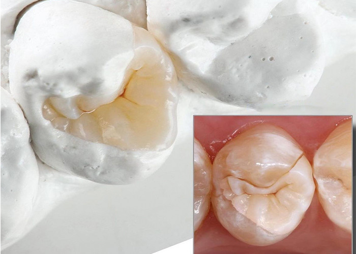 Inlays y onlays cerámicos de aspecto natural para restauración dental precisa de nuestro laboratorio dental experto