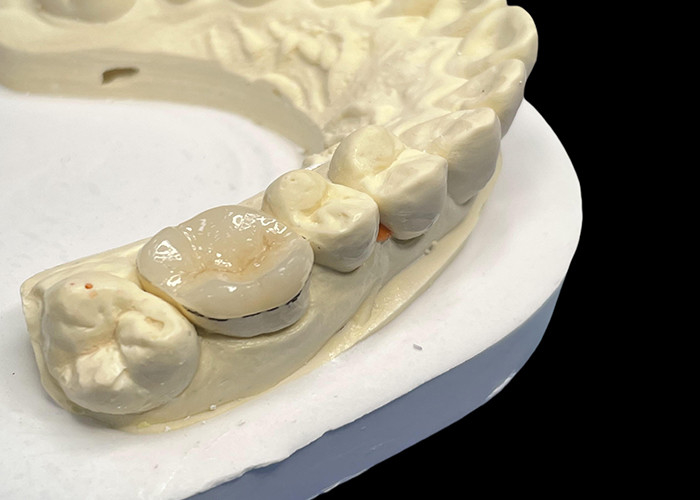 Enlaces de porcelana hipoalergénicos Enlaces para la reparación de dientes Color natural y fácil mantenimiento