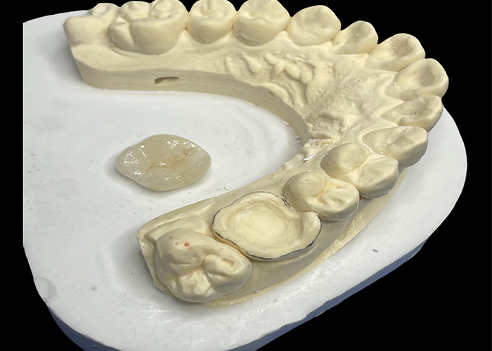 Inlay dental de cerámica para una reparación efectiva de los dientes con soluciones de porcelana duraderas y estéticas para una restauración duradera