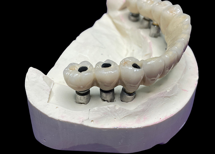 El implante dental con una base de titanio está cubierto con un hermoso puente de corona de cerámica para crear una restauración perfecta.