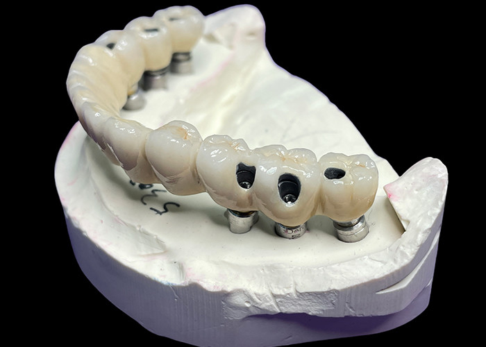 Coronas y puentes de implantes dentales de arco completo que restauran la función y la estética con soluciones avanzadas