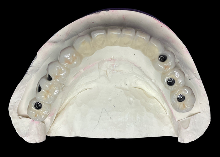 El implante dental con una base de titanio está cubierto con un hermoso puente de corona de cerámica para crear una restauración perfecta.