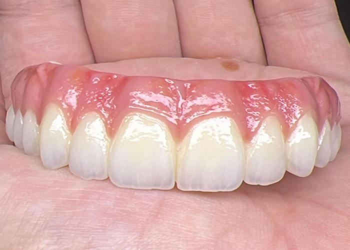 Salud Oral Implante dental Dentaduras con soporte Puente Superficie pulida Soporte de dentaduras completas