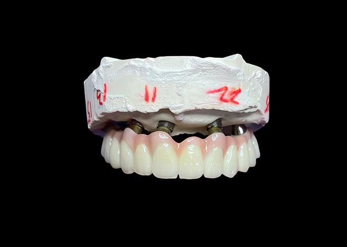 Dentistas con implantes de arco completo fijo para una solución permanente, estable y de aspecto natural a la falta de dientes
