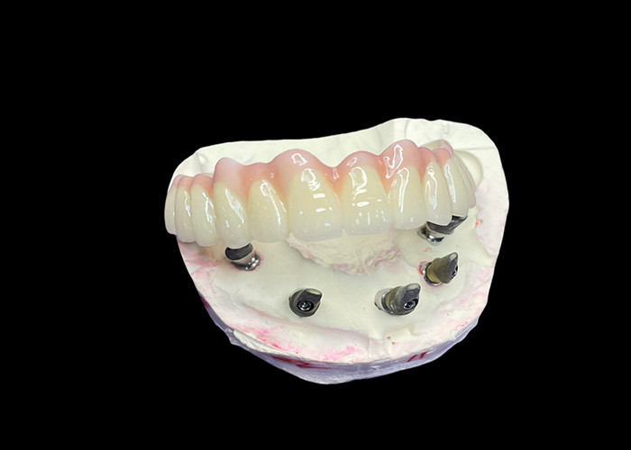 Dentistas con implantes de arco completo fijo para una solución permanente, estable y de aspecto natural a la falta de dientes