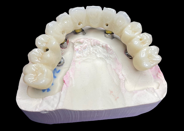 Coronas y puentes de implantes dentales de arco completo que restauran la función y la estética con soluciones avanzadas