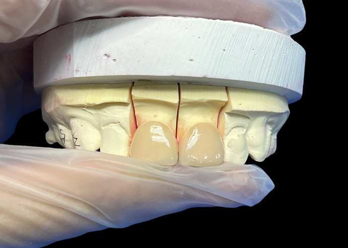 Precisión de resistencia EMAX incisora de chapa de porcelana para restauraciones estéticas de aspecto natural