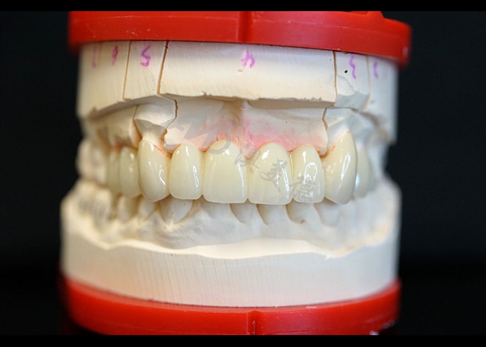 Fortaleza Estética natural Corona de zirconia sólida Perfecto para dientes simples o múltiples