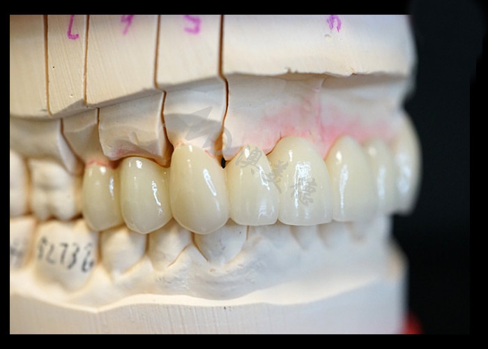 Fortaleza Estética natural Corona de zirconia sólida Perfecto para dientes simples o múltiples