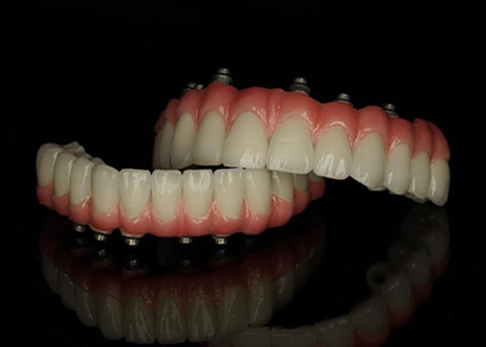 Dentes postizos con base de titanio con implantes fijos con puente de corona de cerámica para reemplazar los dientes perdidos