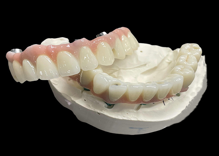 Dentes postizos con base de titanio con implantes fijos con puente de corona de cerámica para reemplazar los dientes perdidos