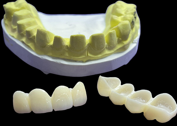 Coronas y puentes de porcelana dental resistentes a las manchas en Vita Tons clásicos para estética natural