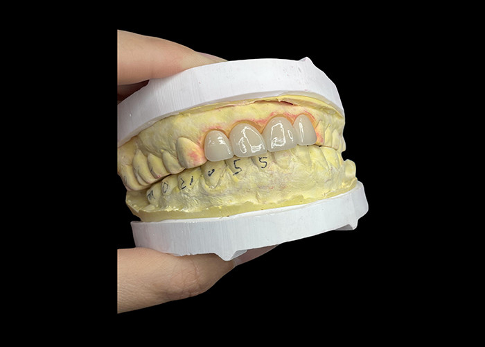 Coronas y puentes de porcelana dental resistentes a las manchas en Vita Tons clásicos para estética natural