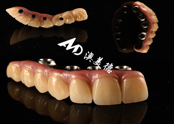 Implante dental de aspecto natural Puente de corona Fijado con pilar de titanio para cirugía de dientes perdidos