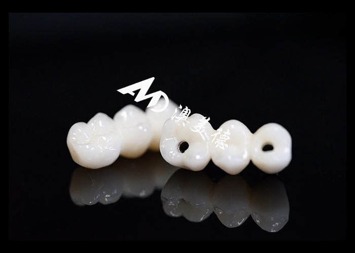 Implante dental de aspecto natural Puente de corona Fijado con pilar de titanio para cirugía de dientes perdidos