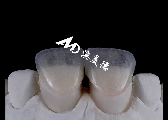 Transforma tu sonrisa con IPS emax Prensa carillas de porcelana Fortaleza Estética y durabilidad combinadas