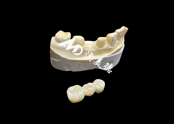 Corona dental de zircónia estética de alta dureza con translucidez y resistencia a las astillas de laboratorio dental de China