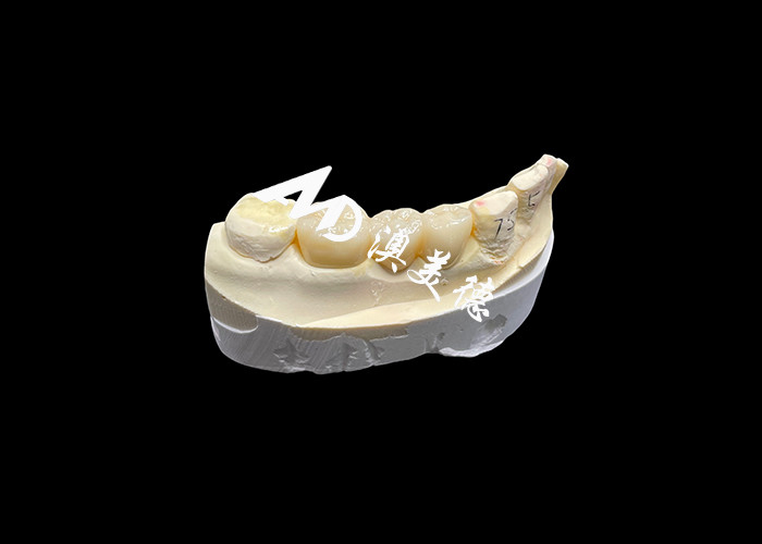 Corona dental de zircónia estética de alta dureza con translucidez y resistencia a las astillas de laboratorio dental de China