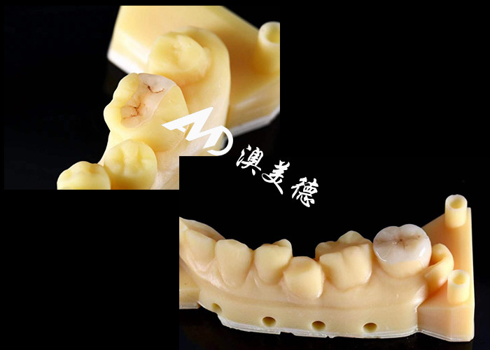 Inlays y onlays cerámicos de precisión para la reparación de dientes con color natural material hipoalergénico y ajuste sin costuras para una comodidad y durabilidad superiores