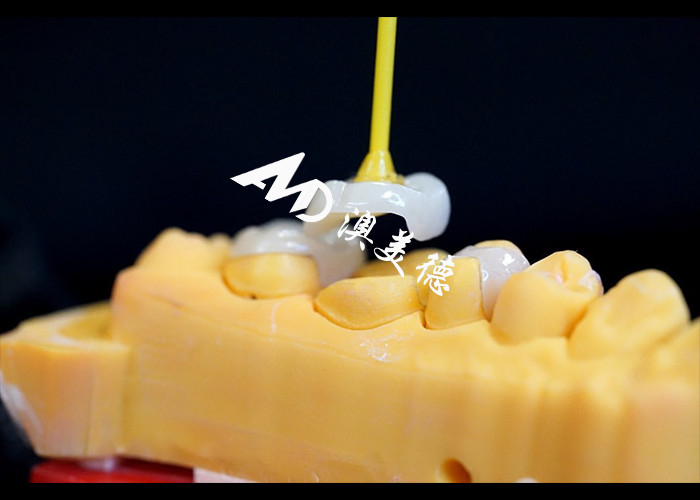 Inlays y onlays cerámicos de precisión para la reparación de dientes con color natural material hipoalergénico y ajuste sin costuras para una comodidad y durabilidad superiores