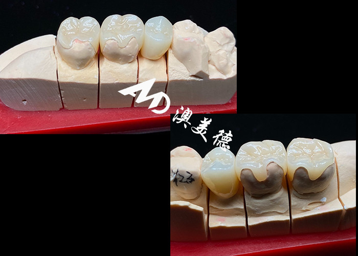 OEM Inlays cerámicos de ajuste de precisión Inlays para restauraciones dentales duraderas y de aspecto natural con resistencia y fiabilidad superiores