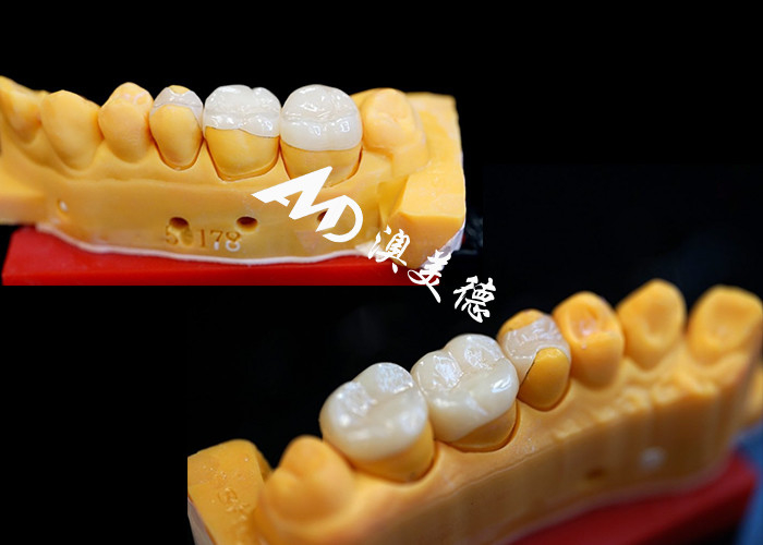 OEM Inlays cerámicos de ajuste de precisión Inlays para restauraciones dentales duraderas y de aspecto natural con resistencia y fiabilidad superiores
