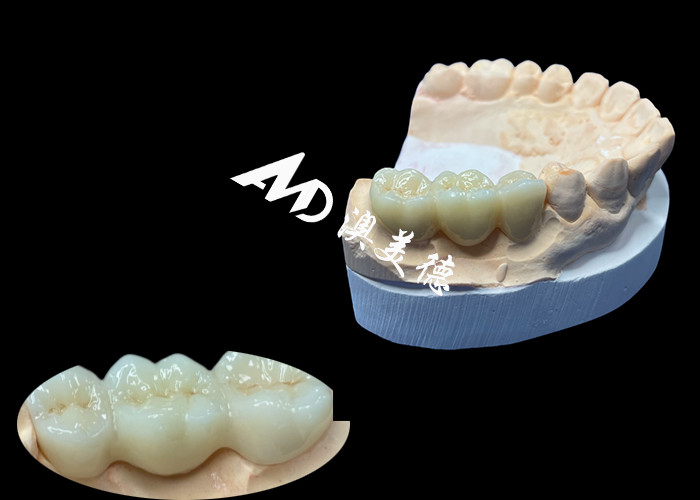 Coroneta dental de zirconio de color natural resistente a las grietas para una sonrisa impecable de laboratorio dental de China