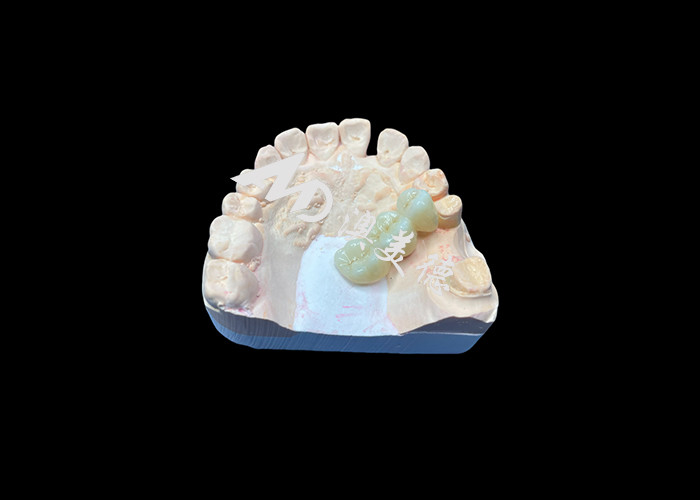 Coroneta dental de zirconio de color natural resistente a las grietas para una sonrisa impecable de laboratorio dental de China