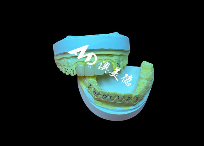 Restauración dental Corona dental de zirconia translúcida para ajuste preciso y estética natural